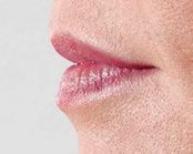 Juvederm Before & After