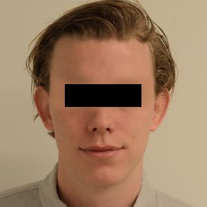 Otoplasty Before & After