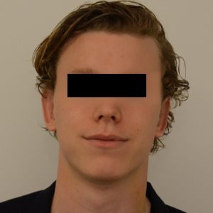 Otoplasty Before & After