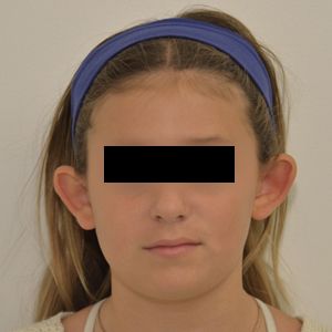 Otoplasty Before & After