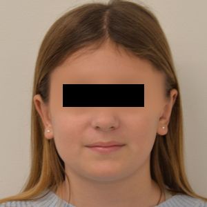 Otoplasty Before & After