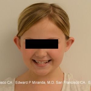 Otoplasty Before & After