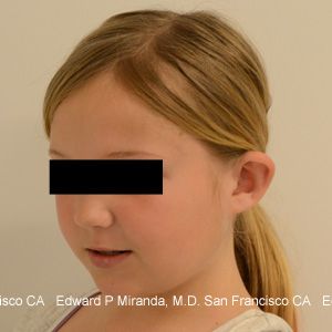 Otoplasty Before & After