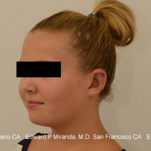 Otoplasty Before & After