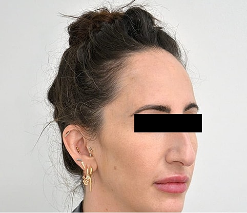 Hairline Lowering Before & After