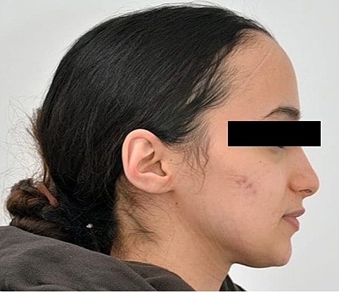 Hairline Lowering Before & After