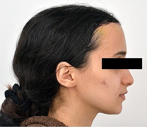 Hairline Lowering Before & After