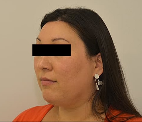 Hairline Lowering Before & After