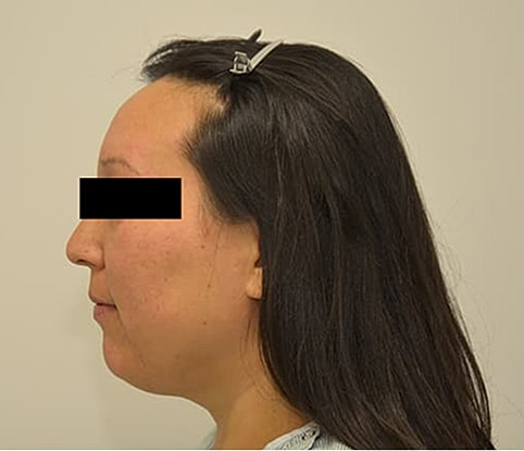 Hairline Lowering Before & After