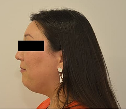 Hairline Lowering Before & After