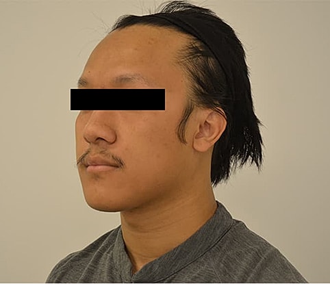 Hairline Lowering Before & After