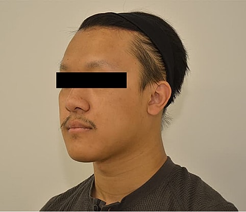 Hairline Lowering Before & After