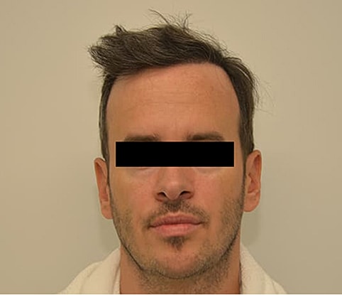 Hairline Lowering Before & After