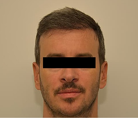 Hairline Lowering Before & After