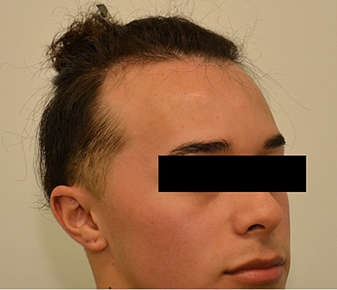 Hairline Lowering Before & After