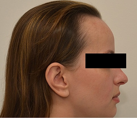 Hairline Lowering Before & After