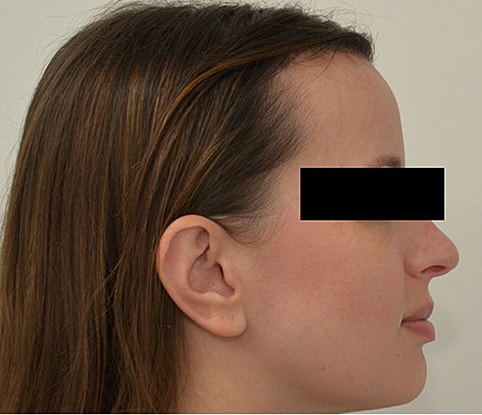 Hairline Lowering Before & After