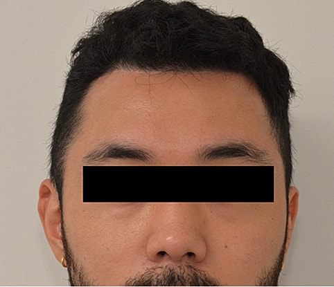 Hairline Lowering Before & After