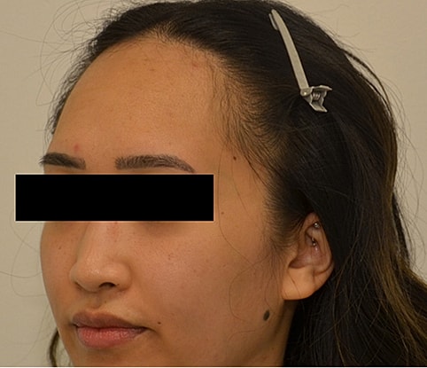 Hairline Lowering Before & After