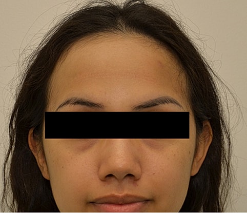 Hairline Lowering Before & After