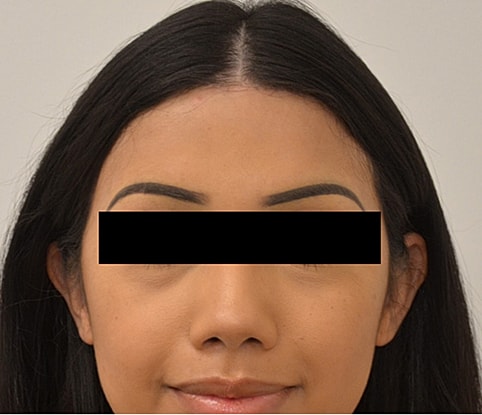 Hairline Lowering Before & After