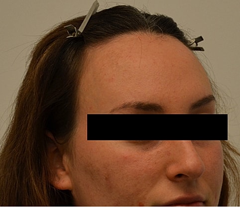 Hairline Lowering Before & After