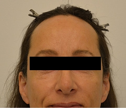 Hairline Lowering Before & After