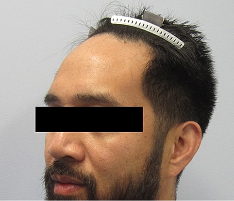 Hairline Lowering Before & After