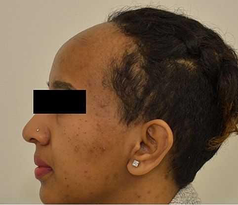 Hairline Lowering Before & After