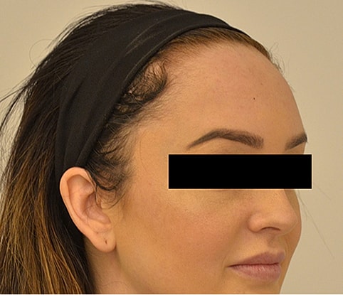 Hairline Lowering Before & After