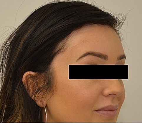 Hairline Lowering Before & After