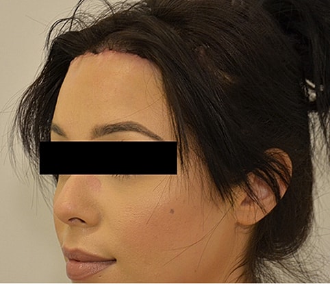 Hairline Lowering Before & After