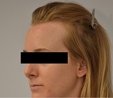 Hairline Lowering Before & After