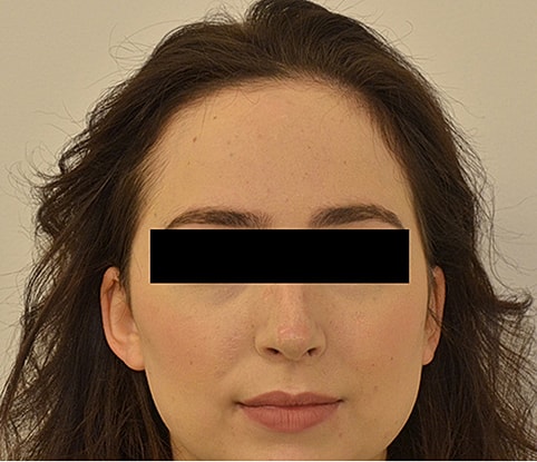 Hairline Lowering Before & After