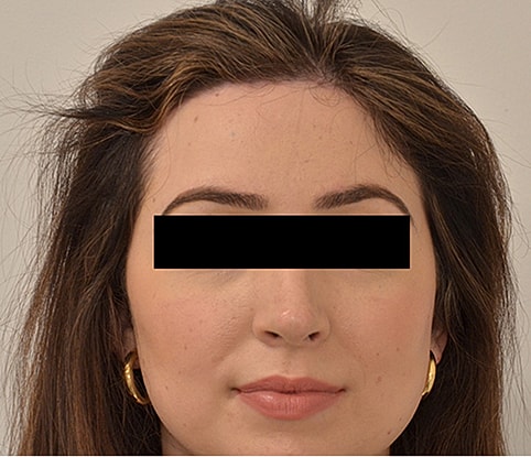 Hairline Lowering Before & After