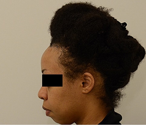 Hairline Lowering Before & After