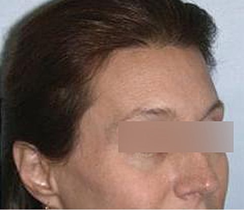 Hairline Lowering Before & After