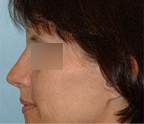 Hairline Lowering Before & After