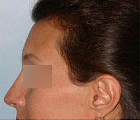 Hairline Lowering Before & After