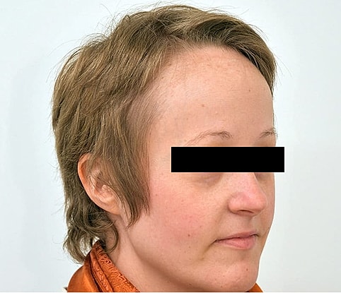 Hairline Lowering Before & After
