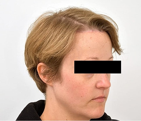 Hairline Lowering Before & After