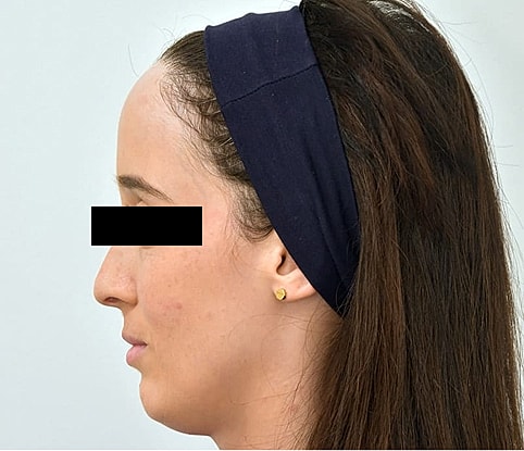 Hairline Lowering Before & After