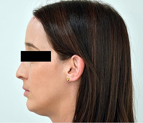 Hairline Lowering Before & After