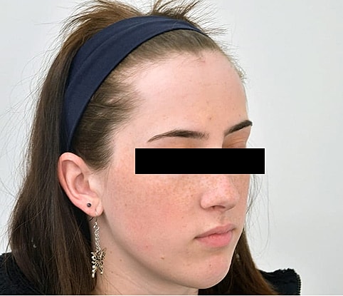 Hairline Lowering Before & After