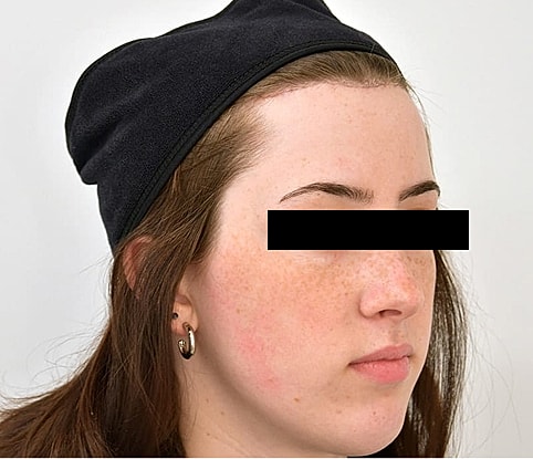 Hairline Lowering Before & After