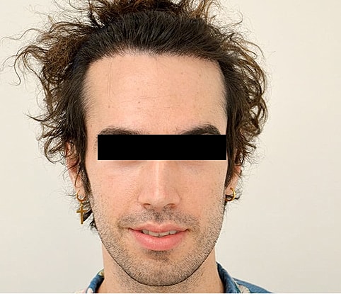 Hairline Lowering Before & After