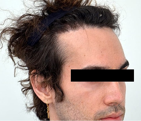 Hairline Lowering Before & After