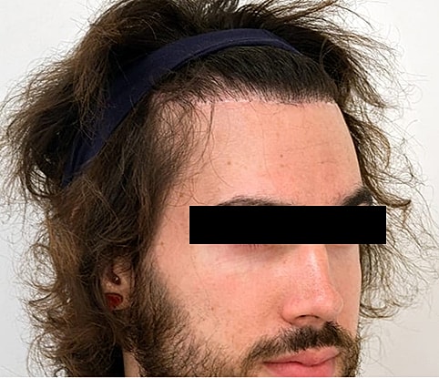 Hairline Lowering Before & After