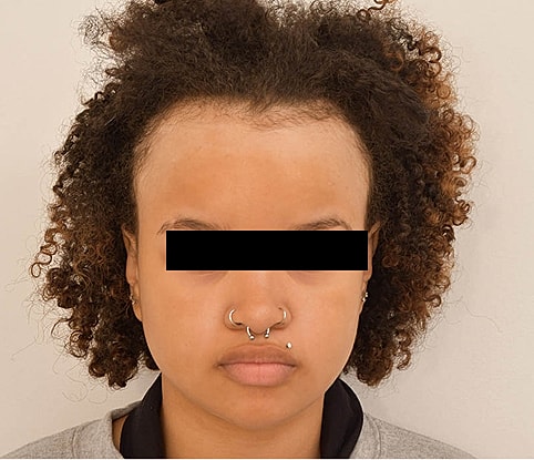 Hairline Lowering Before & After