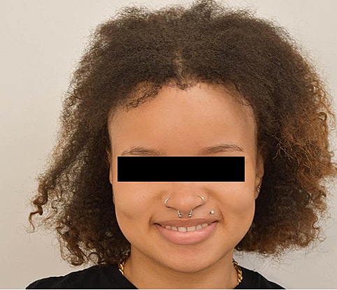 Hairline Lowering Before & After